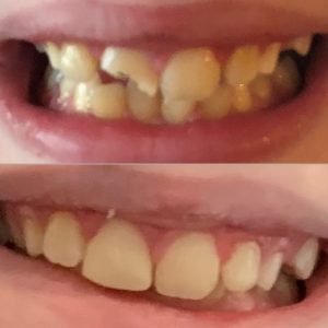 Same-Day Cerec Crowns our before & after results in 1-2 Hours Paramus NJ