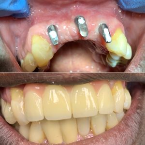 Our Before and After Dental Implants Paramus NJ