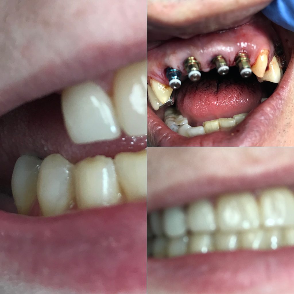 Dental Implants in Paramus, NJ Paramus Park Mall Dental