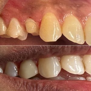 Same-Day Cerec Crowns Before and After Results in 1-2hrs