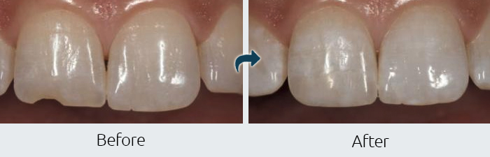 Before After Cosmetic Bonding at Paramus Park Mall Dental
