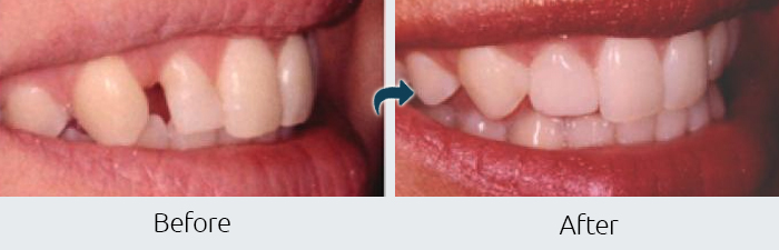Example of Before After Cosmetic Bonding at Paramus Park Mall Dental