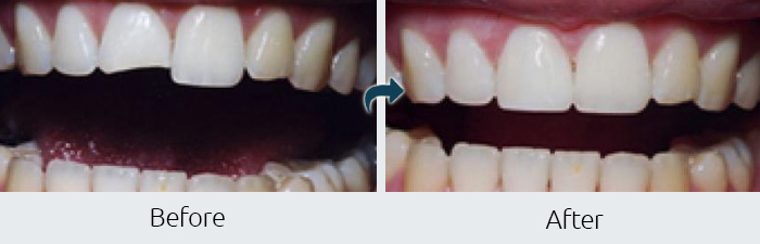 Second Example of Before After Cosmetic Bonding at Paramus Park Mall Dental