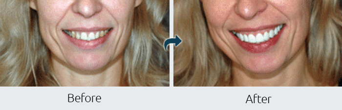 Example of Cosmetic Crowns at Paramus Park Mall Dental
