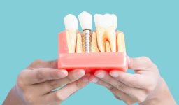 Why Dental Implant Technology is Better for Your Smile